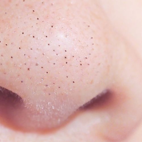 How to use baking soda to remove blackheads